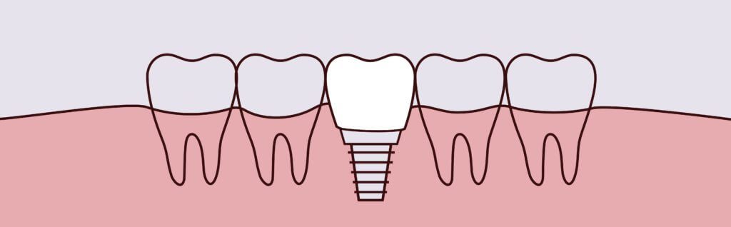 dental implants dentist Kansas City